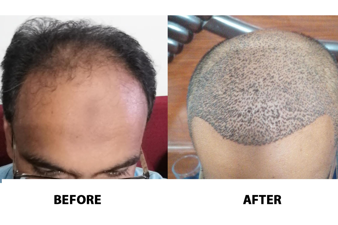 Hair Transplant Clinic in Lahore